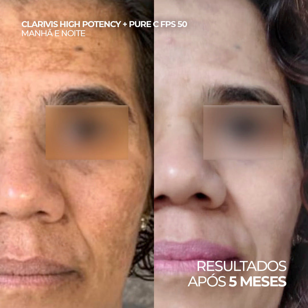 Sérum Facial Clareador com Triplo Ácido para Manchas, Melasma e Hiperpigmentação – Clarivis High Potency 30 ml