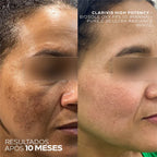 Sérum Facial Clareador com Triplo Ácido para Manchas, Melasma e Hiperpigmentação – Clarivis High Potency 30 ml