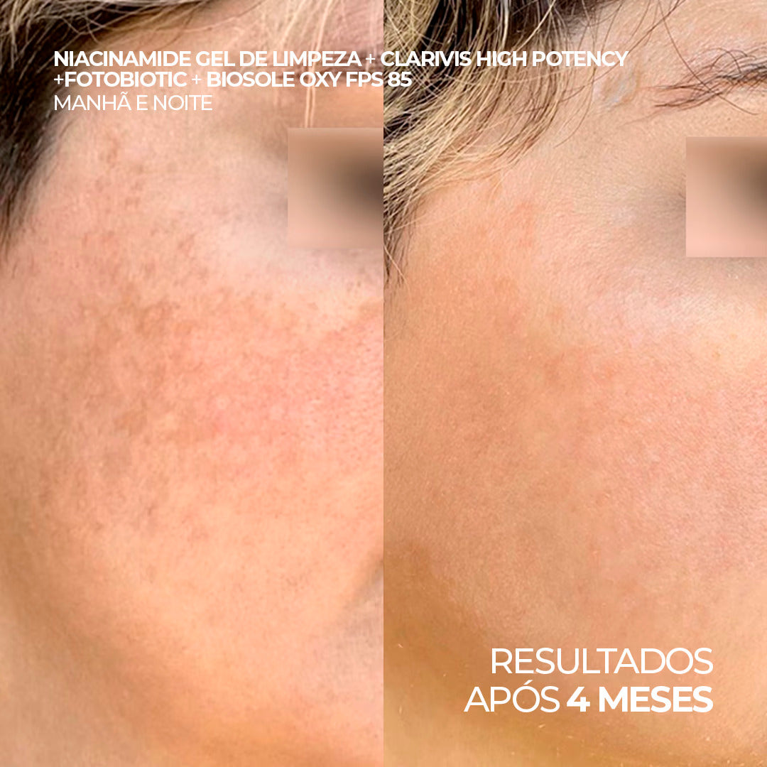 Sérum Facial Clareador com Triplo Ácido para Manchas, Melasma e Hiperpigmentação – Clarivis High Potency 30 ml