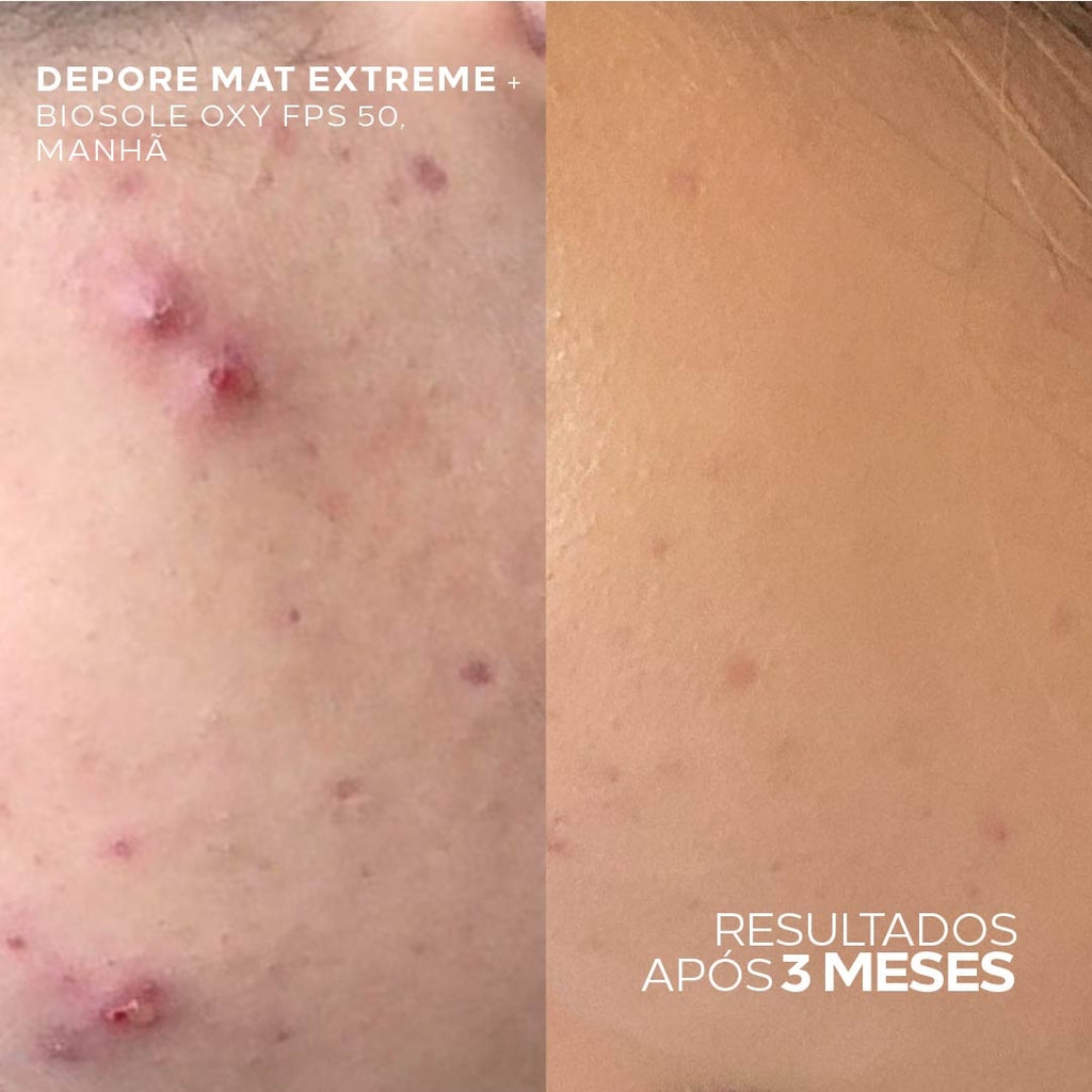 Kit para Pele Oleosa com Protetor Solar Matte FPS 50 + Hidratante Anti-Oleosidade