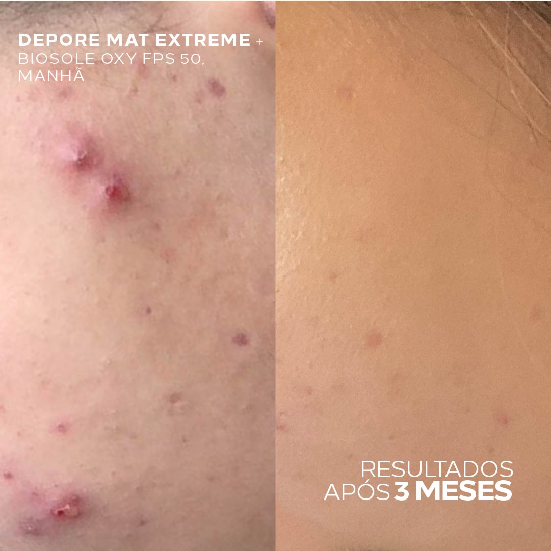 Kit para Pele Oleosa com Protetor Solar Matte FPS 50 + Hidratante Anti-Oleosidade