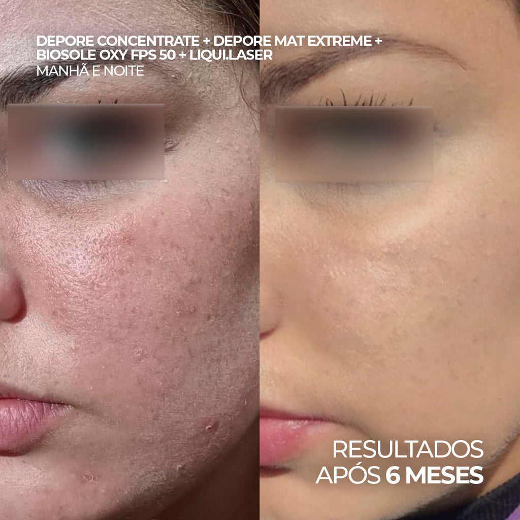 Kit para Pele Oleosa com Protetor Solar Matte FPS 50 + Hidratante Anti-Oleosidade